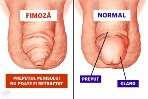 Circumcizie - Wikipedia